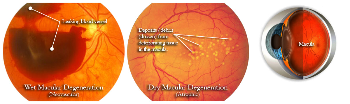 Macular Degeneration optic nerve